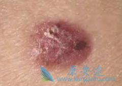 ����ϸ����֢״����Щ��������β����緢��������