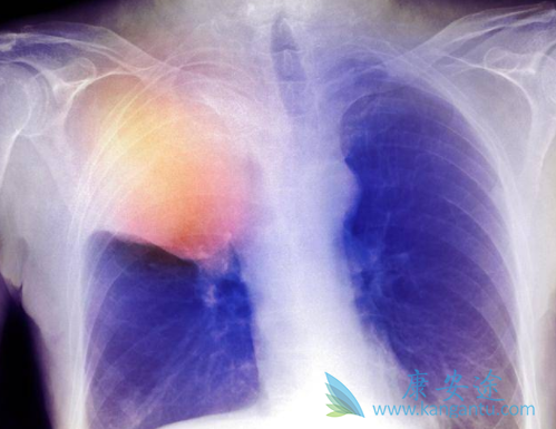 Lorlatinib Lorlatinib