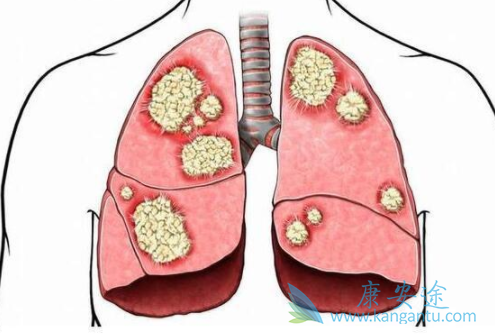 小细胞肺癌 小细胞肺癌