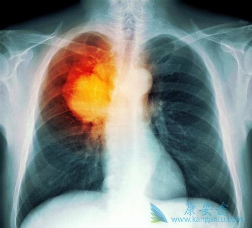 小细胞肺癌 小细胞肺癌