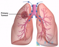 ��������(Cometriq)����MET��ROS1ͻ��ķΰ�����Ч����ô����