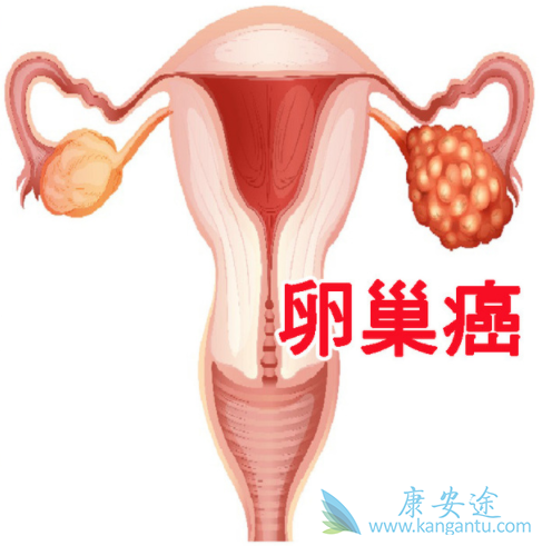 卵巢癌 卵巢癌