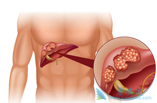 卡博替尼 卡博替尼