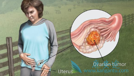 复发卵巢癌患者 复发卵巢癌患者
