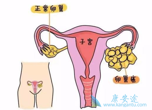 卵巢癌的早期症状 卵巢癌的早期症状