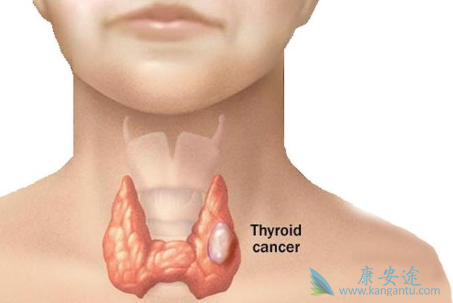 甲状腺癌的早期症状 甲状腺癌的早期症状