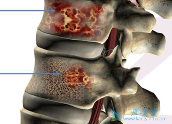 骨髓瘤能治好吗 骨髓瘤能治好吗