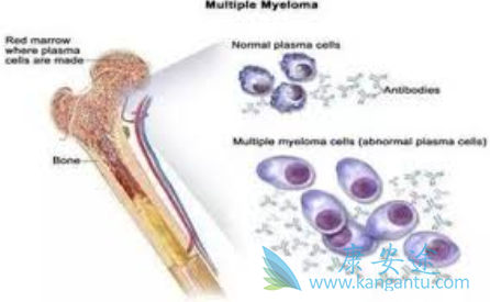 多发性骨髓瘤治疗 多发性骨髓瘤治疗