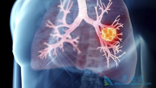 晚期肺癌治疗;肺癌 晚期肺癌治疗;肺癌