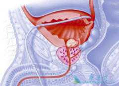 ǰ���ٰ���ҩ����³��(Apalutamide)������������