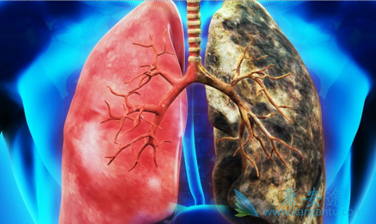 肺癌脑转移 肺癌脑转移