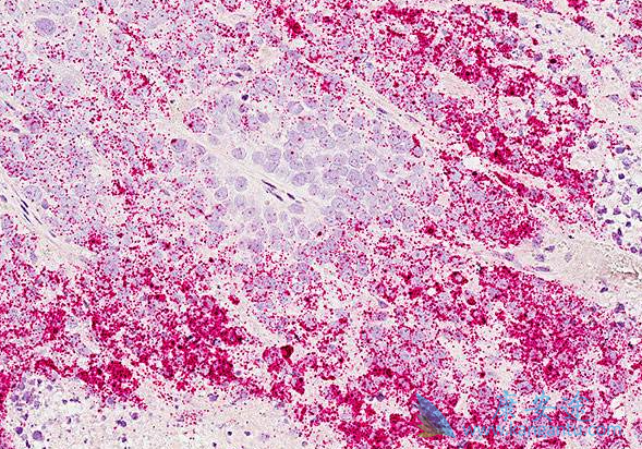 乳腺癌的早期治疗 乳腺癌的早期治疗