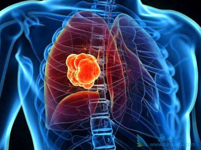 肺癌的症状有哪些? 肺癌的症状有哪些?