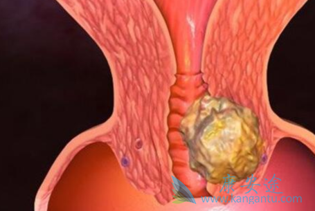 �ѳ���������֢״;�ѳ���