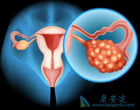 卵巢癌;治疗卵巢癌 卵巢癌;治疗卵巢癌