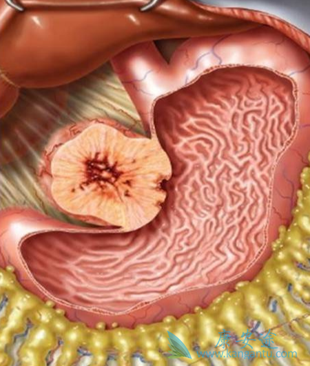 胃肠间质瘤;舒尼替尼 胃肠间质瘤;舒尼替尼