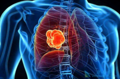 ��������(Lorlatinib)�ܺܺõ�����ROS1��������ҩͻ��