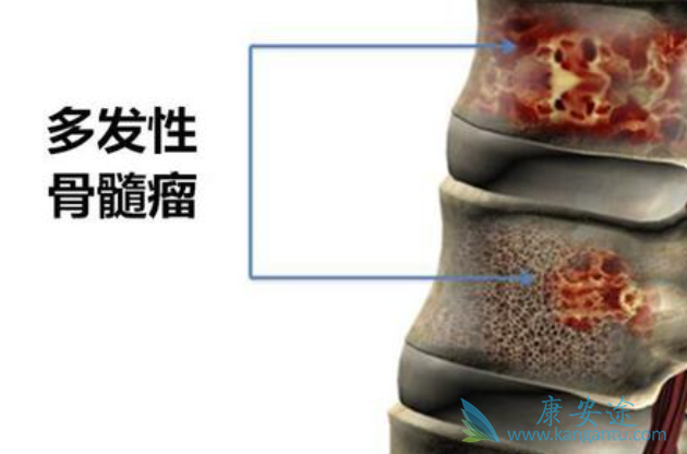 骨髓瘤能活多久 骨髓瘤能活多久