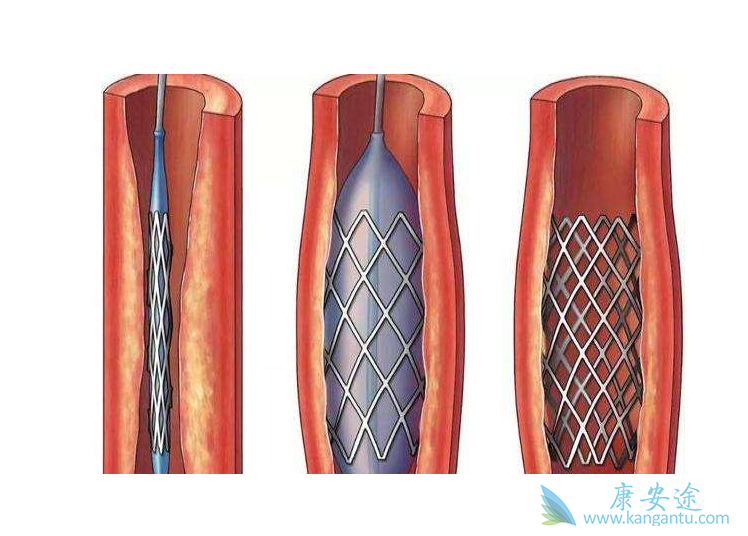 心脏支架 心脏支架