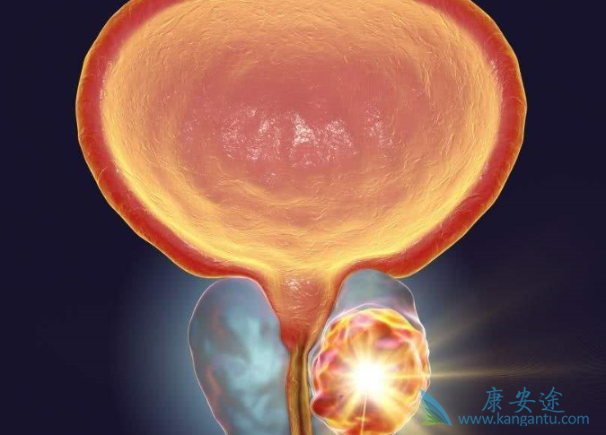 前列腺癌治疗 前列腺癌治疗