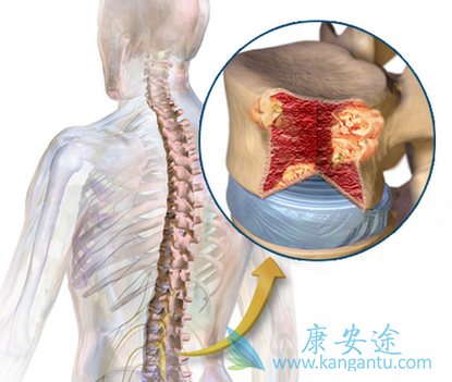 多发性骨髓瘤 多发性骨髓瘤